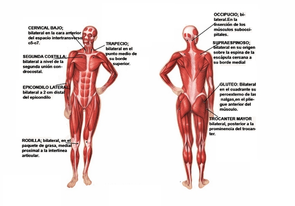 Puntos Gatillos o de Sensibilidad Neuromuscular