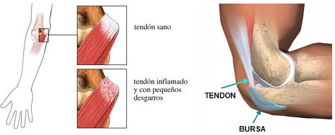 Tendones