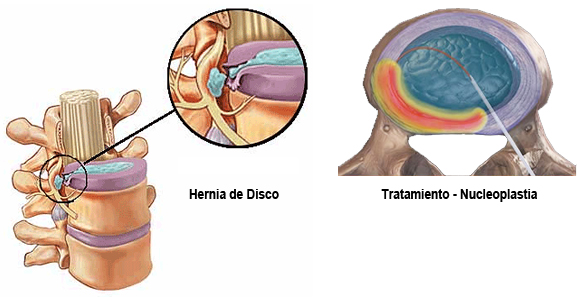 Tratamientos Hernia de Disco